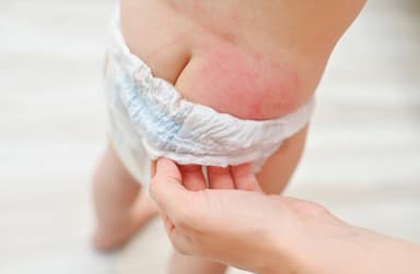A parent easing a nappy waistband down to show an area of pink, irritated skin across a baby's hip and buttock