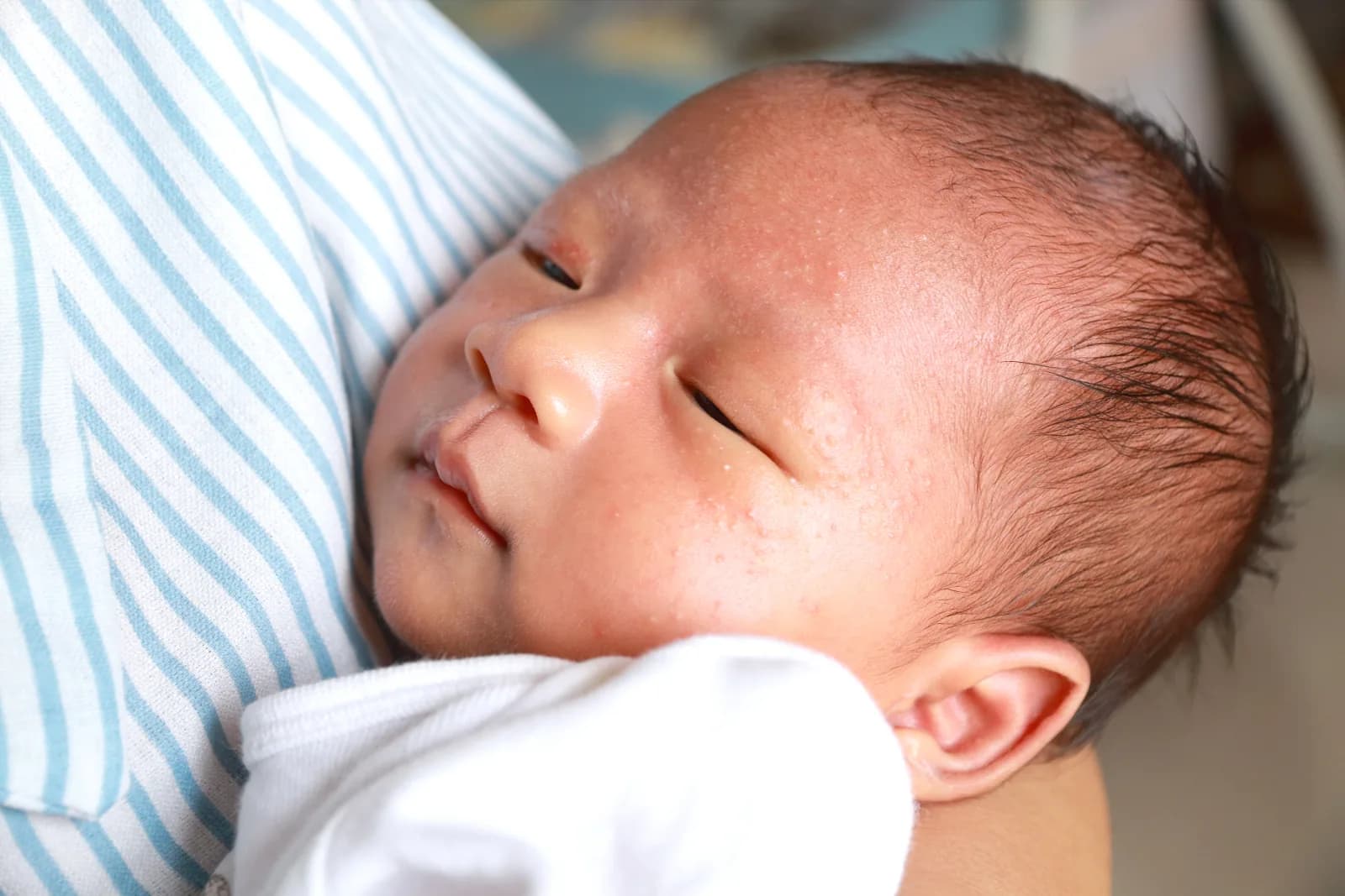 Close-up of a sleeping newborn's face showing fine pinpoint heat rash spots across the forehead and cheek